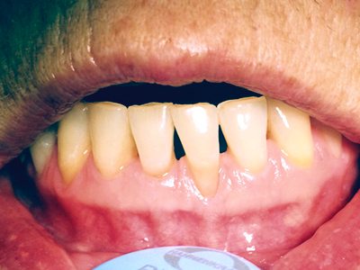 Zahnfleisch-Transplantation vorher