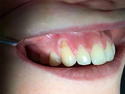 Zahnfleischtransplantation vorher